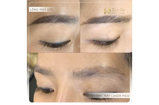 xoa-xam-long-may-bang-laser-gia-bao-nhieu (1)
